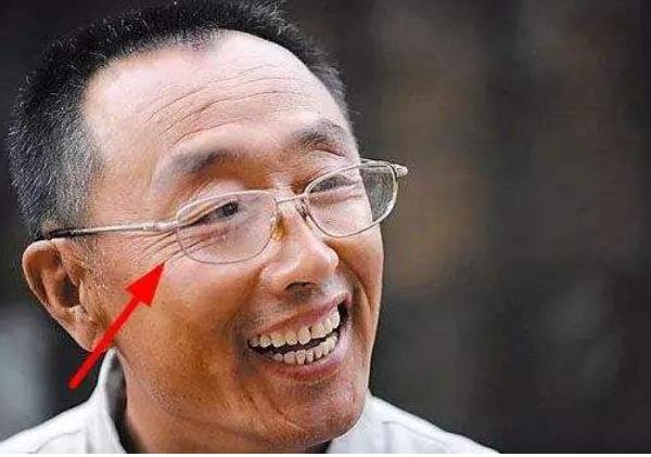 怎样才算好痣 头顶长痣贵人运势好